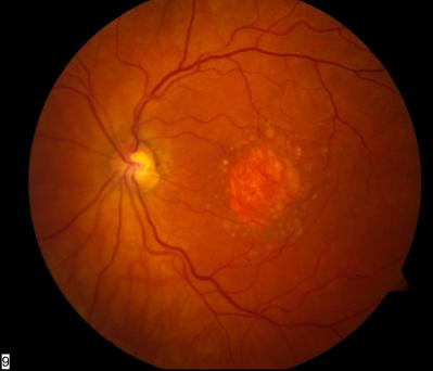 Dry Macular Degeneration