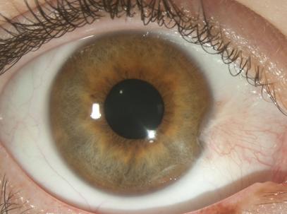 Pterygium before surgery