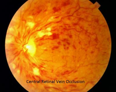 Retinal Vein Occlusion