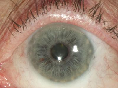 Severe pterygium after surgery