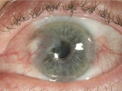 Severe pterygium before surgery