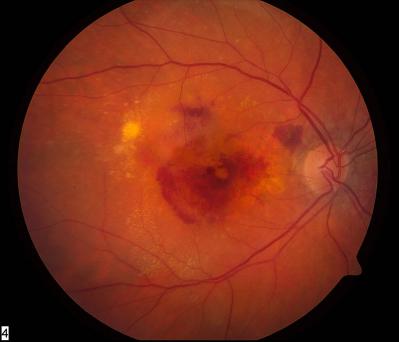 Wet Macular Degeneration