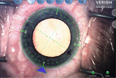 cataract